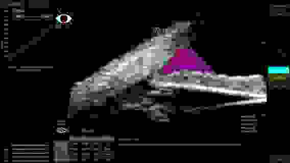 Офтальмологическая ультразвуковая система VuMax HD с принадлежностями, Sonomed Inc., США// VuMax-HD (A,B20,UBM)