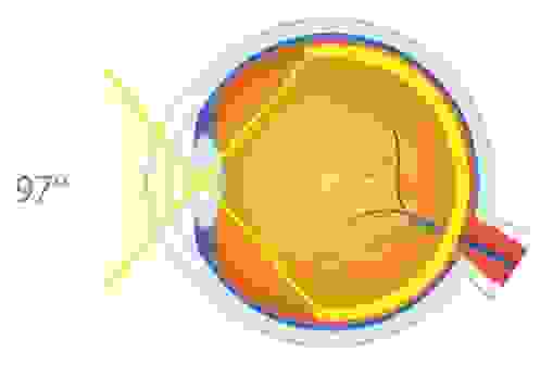 Линза 78D, Mediworks